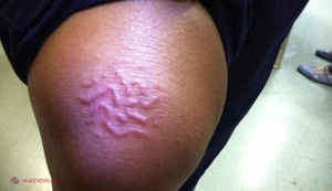 O femeie s-a ales cu o iritaţie la genunchi. Lucrurile au luat o turnură ÎNGROZITOARE atunci când iritaţia a început să se mişte