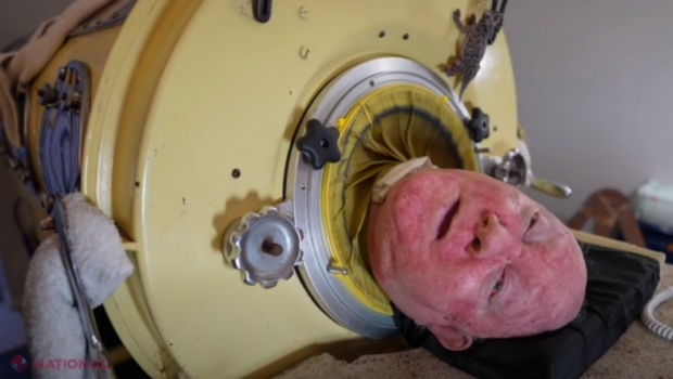 Bărbatul care a trăit 70 de ani într-un cilindru metalic a murit la 78 de ani. Povestea lui Paul care a trăit în „plămânul de fier”  