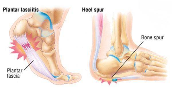 tratamentul osteoartrozei călcâiului alevia balsam gheara diavolului