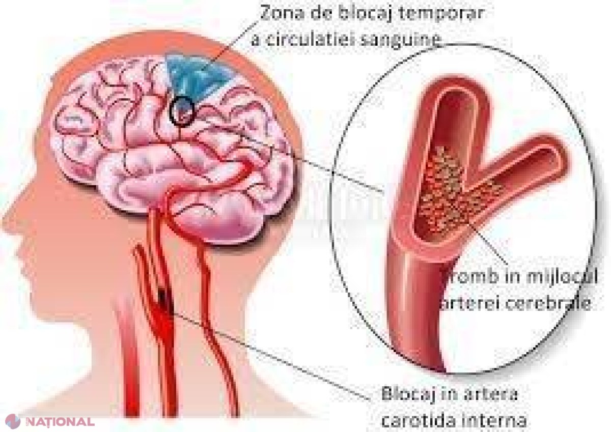 Accidentul vascular cerebral, una dintre cele mai de temut boli