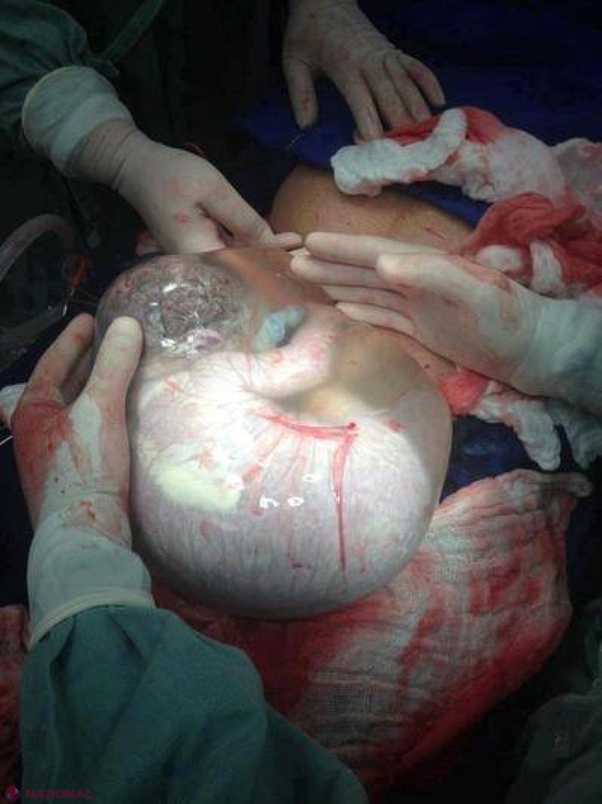 FOTO // „Este incredibil, un astfel de caz este ULTRA RAR”. Medicul care asista la naştere a avut surpriza vieţii 