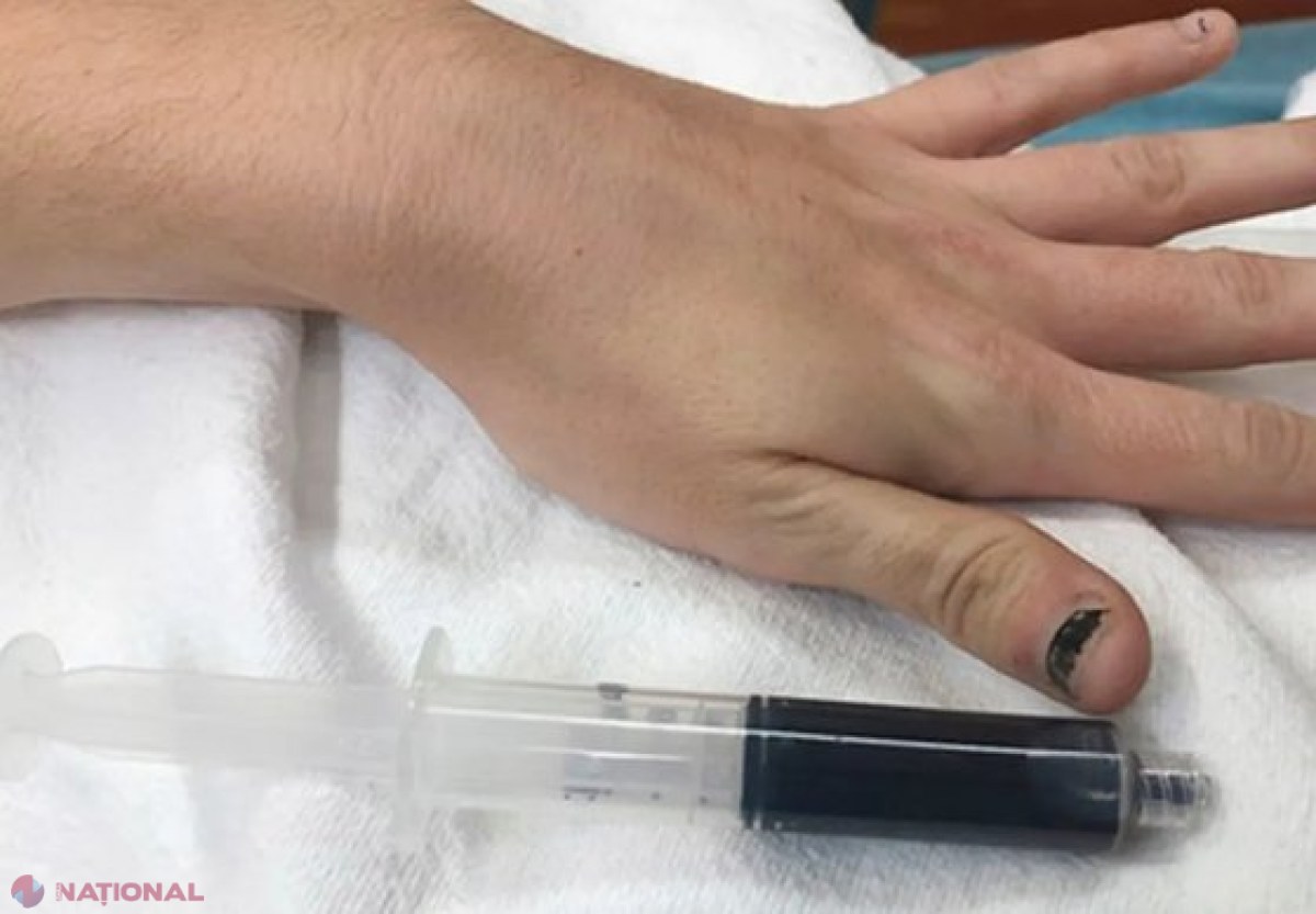 Caz confirmat de „sânge albastru”: Cum au diagnosticat medicii o tânără, care s-a prezentat cu simptome neobişnuite la spital