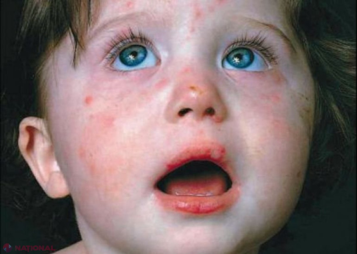 Atenție, mămici! Bacteria care produce această boală este foarte periculoasă. Protejați-vă copiii!