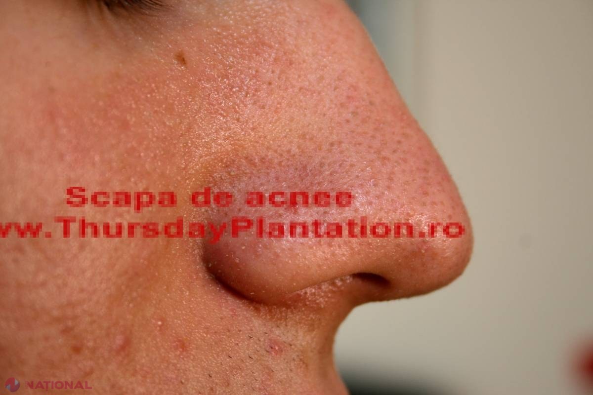 VIDEO // Metodă senzaţională! Scapă de PUNCTELE NEGRE de pe nas în doar câteva secunde
