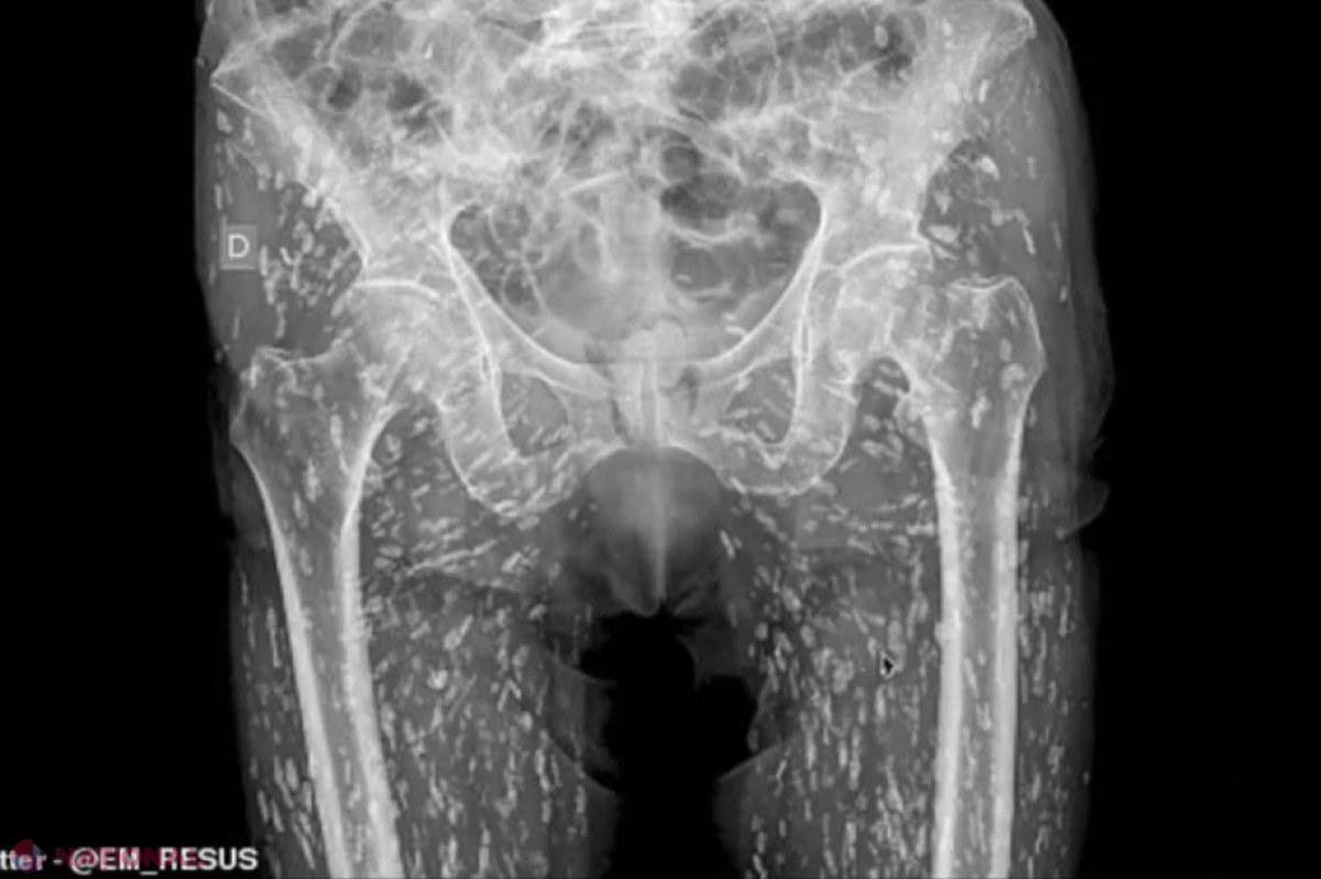 Imagine șocantă: Bărbat infestat cu ouă de tenie în tot corpul de la acest aliment​. Tratament și prevenție