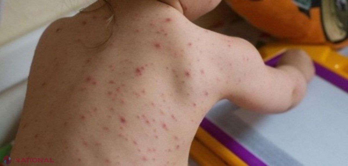 RUJEOLĂ în UTA Găgăuzia: Un grup de copii care au fost la o tabără în Odesa s-au întors bolnavi acasă. Doar unul era vaccinat