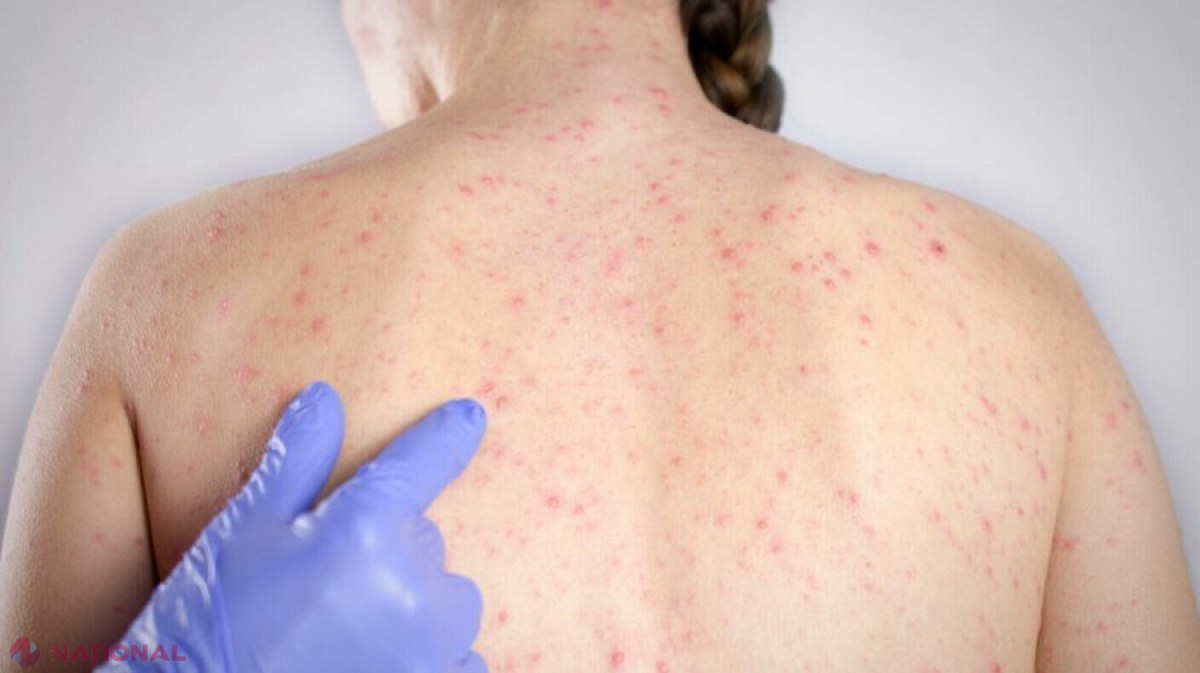 Alertă de rujeolă: Familii nevaccinate aduc virusul din vacanța petrecută la Bukovel