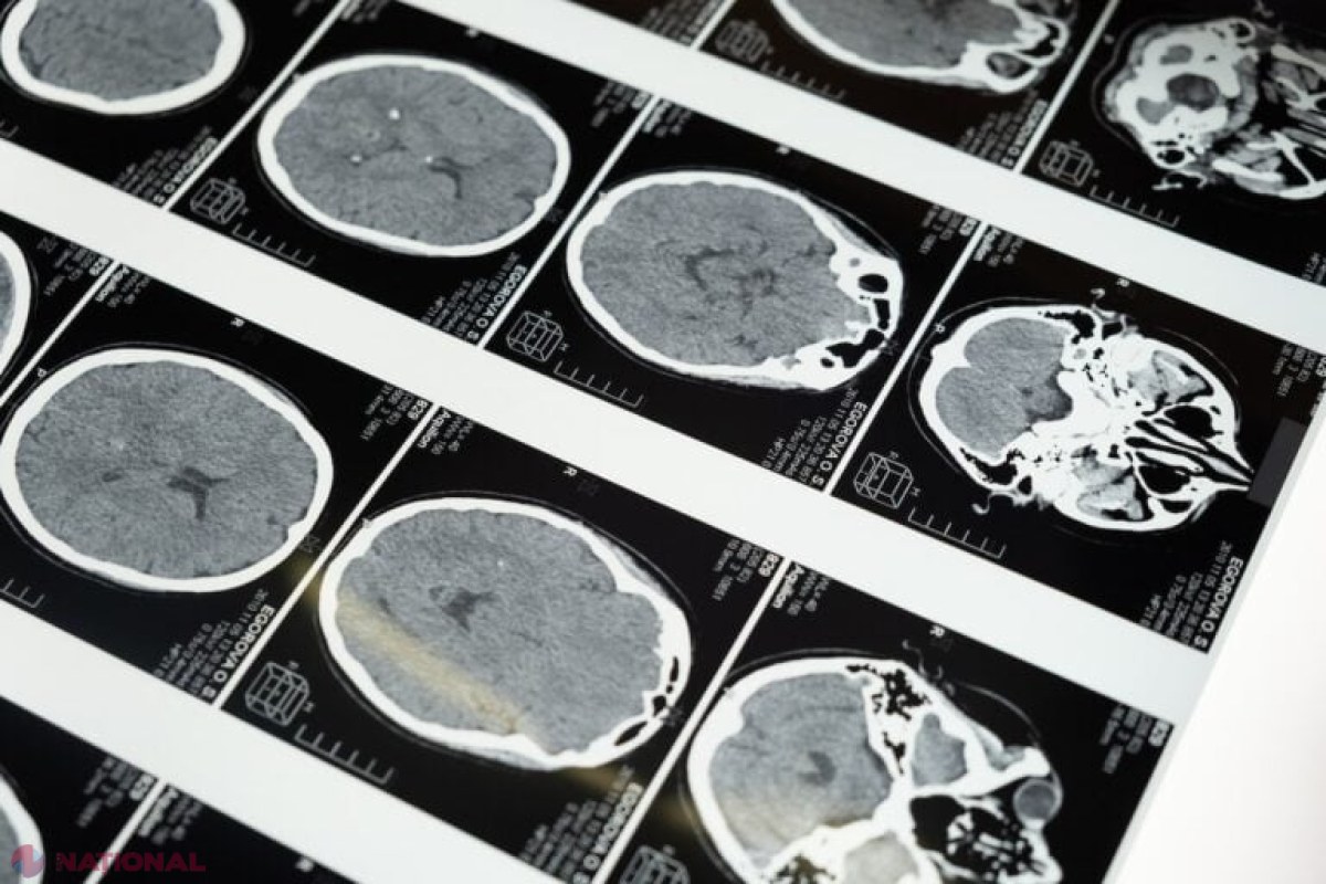 Descoperire revoluționară: Tipare neuronale ar putea transforma terapiile pentru Parkinson, oferind speranță pacienților