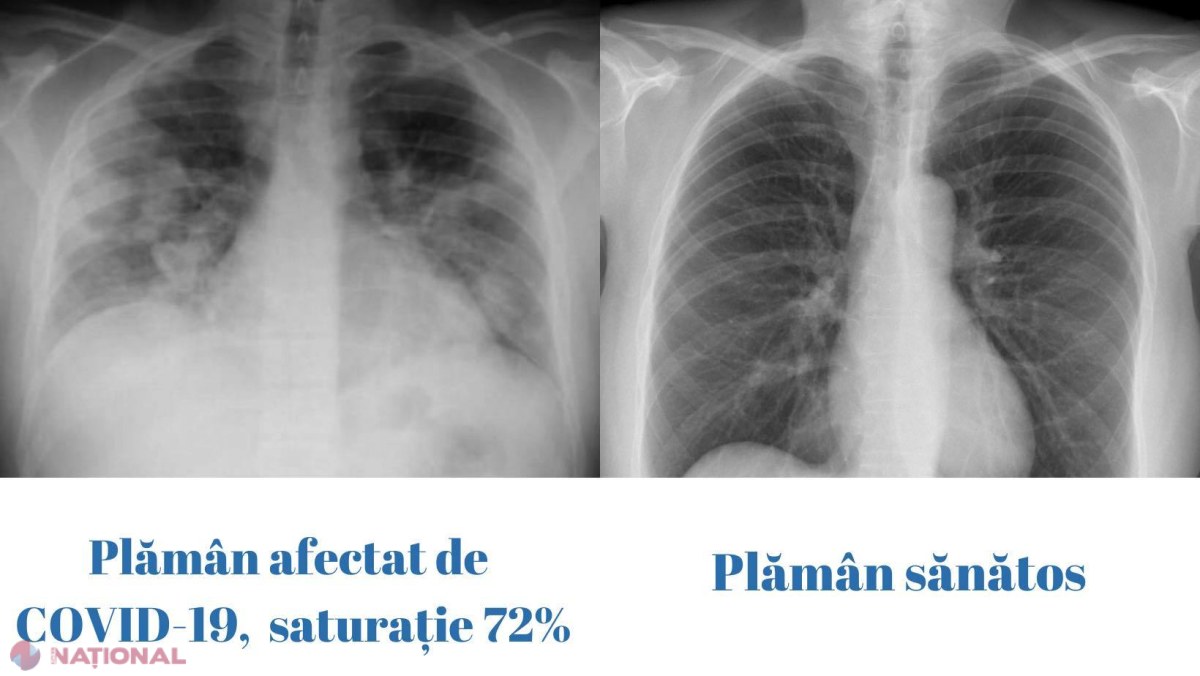 Pacient din SUA menținut în viață 48 de ore fără plămâni, cu ajutorul unui sistem artificial, până la dublul transplant pulmonar