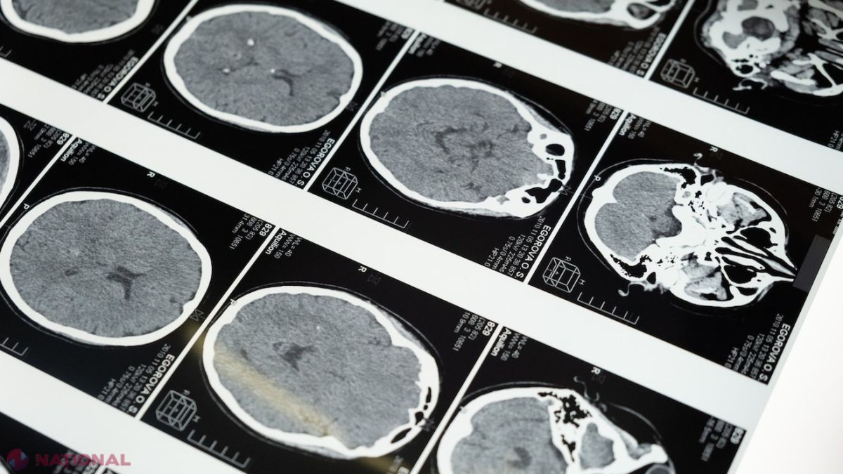 Japonia dă undă verde primelor terapii cu celule stem iPS pentru Parkinson și afecțiuni cardiace