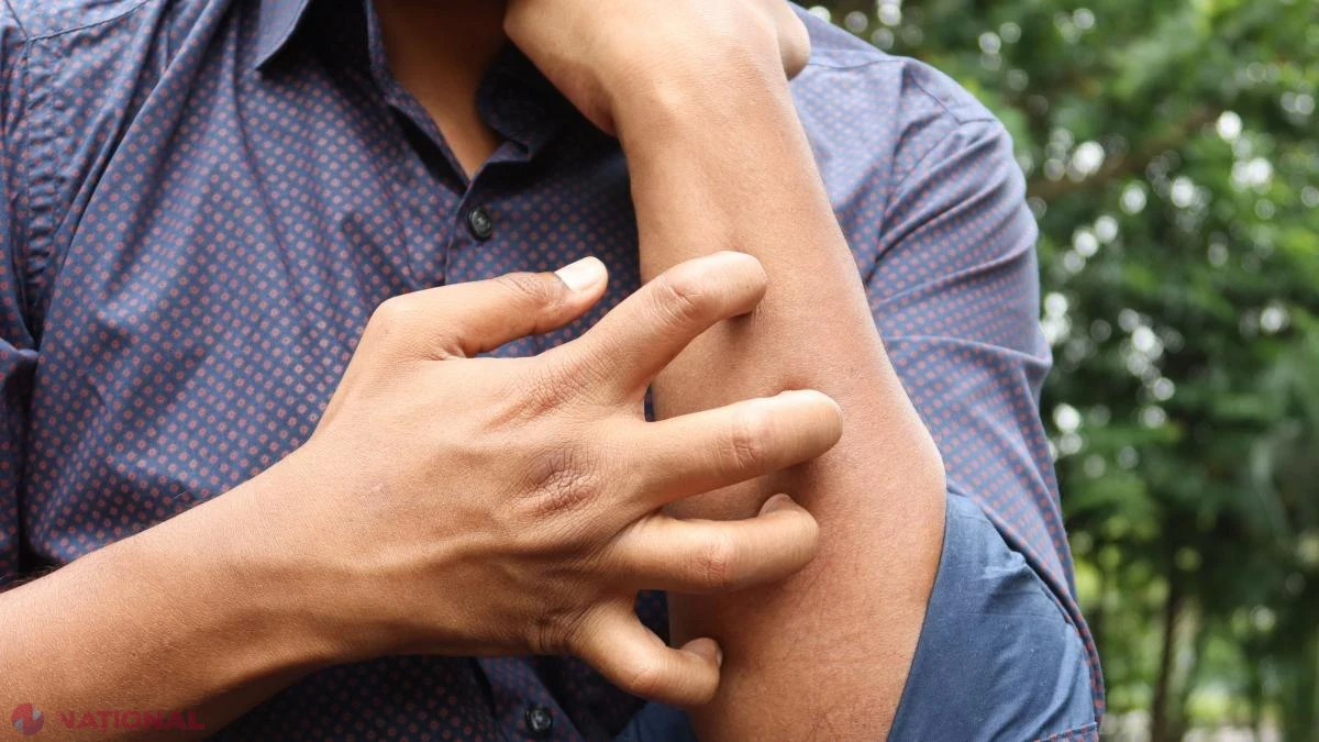 Dermatita atopică nu afectează doar pielea: boala perturbă somnul, școala și viața de zi cu zi