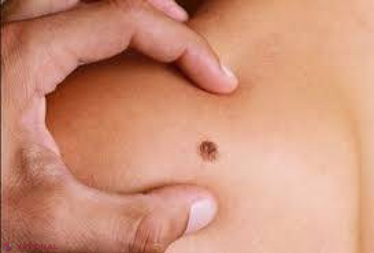 Povestea emoționantă a unei femei diagnosticate cu CANCER de piele