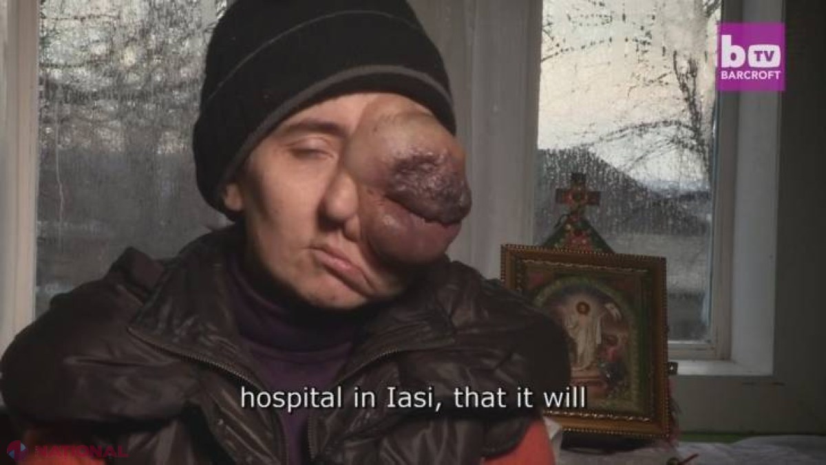 VIDEO // Drama Nicoletei - o tumoare enormă la unul dintre ochi. Doctorii nu au idee cum ar putea să o opereze fără să îi afecteze viaţa