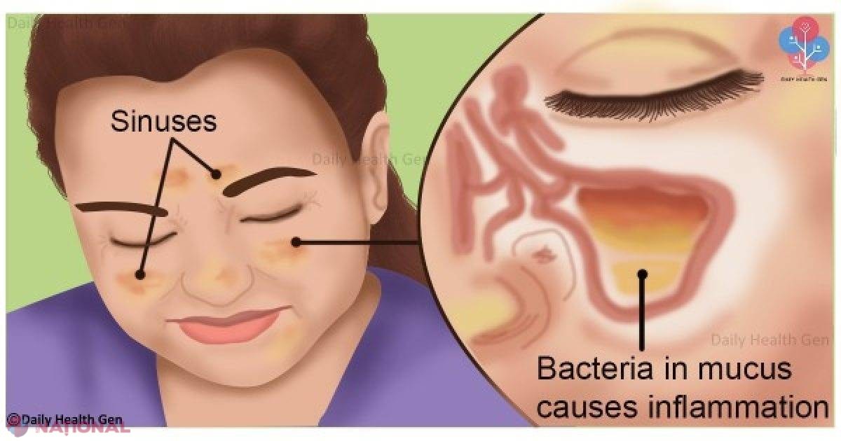 Scapă de INFECȚIA SINUSURILOR în 20 de secunde cu aceste ingrediente pe care le ai în casa ta