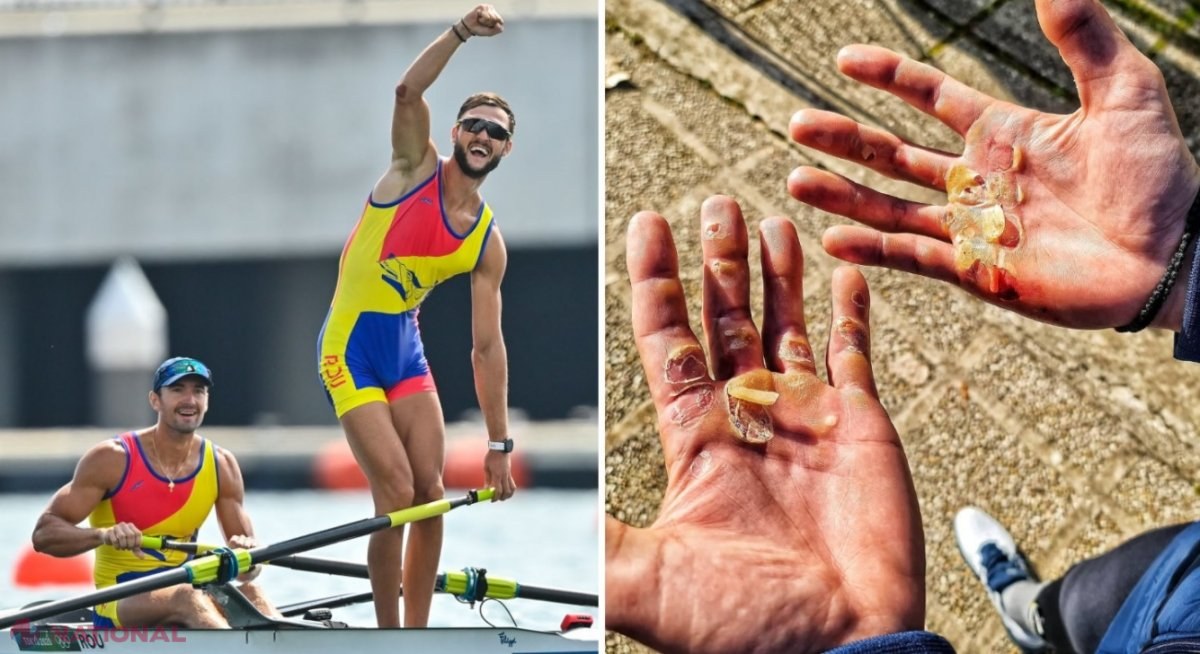 Suferințele din spatele unei MEDALII olimpice. Poza cu palmele medaliatului Ciprian Tudosă, dovada sacrificiilor uriașe