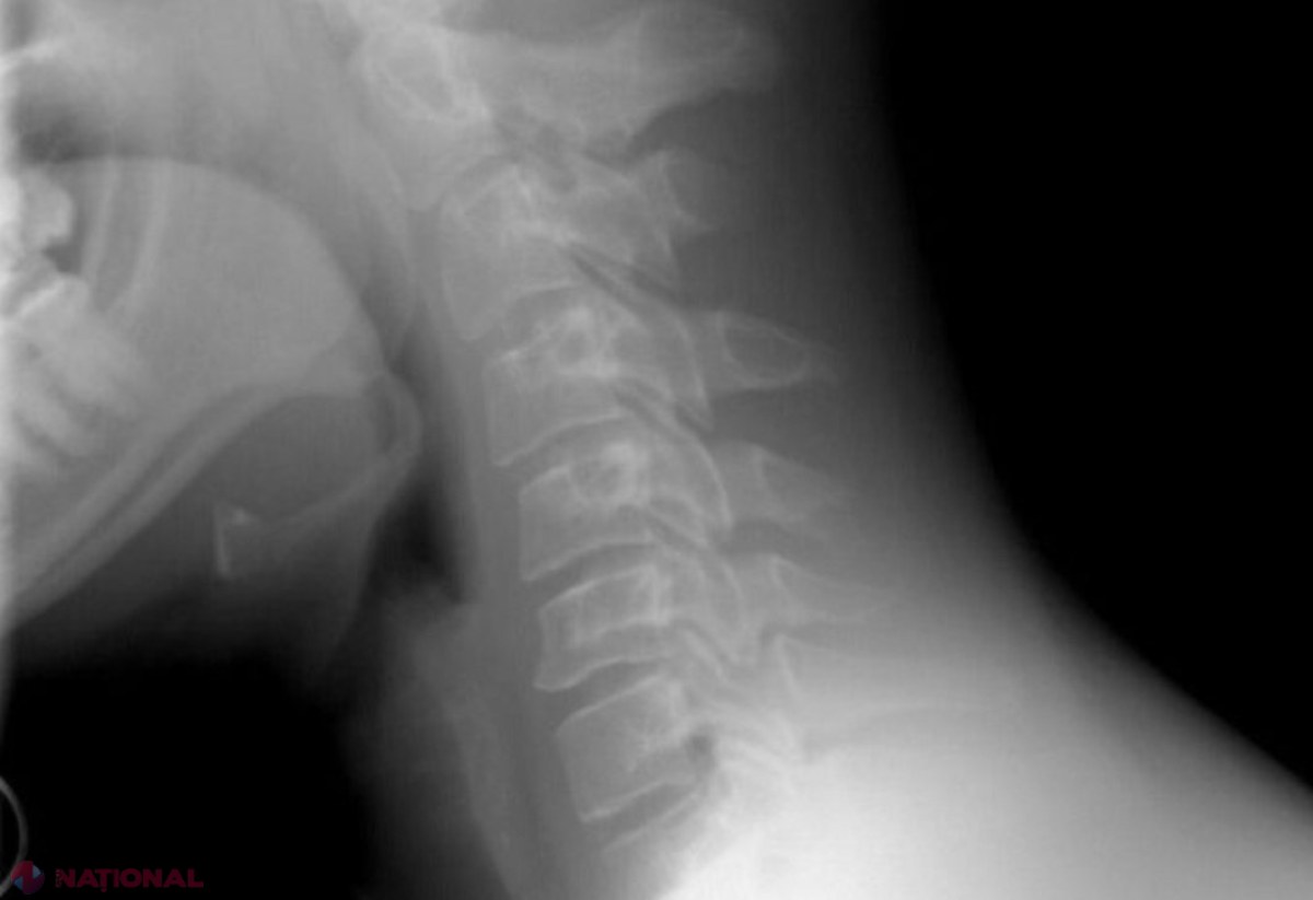 Implant revoluționar care ajută la regenerarea naturală a oaselor