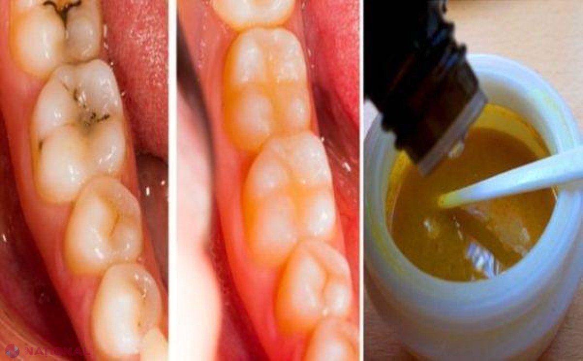 Scapă de carii în mod natural şi vindecă degradarea dinţilor cu această soluţie uimitoare pentru dinţi!