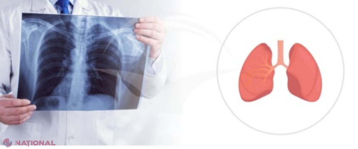 R. Moldova, printre primele 40 de state din lume cu cele mai multe îmbolnăviri de tuberculoză