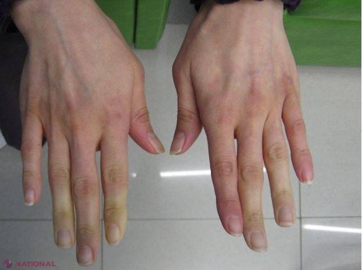 Ai mâinile şi picioarele RECI? Iată semnalul de ALARMĂ pe care ţi-l transmite corpul