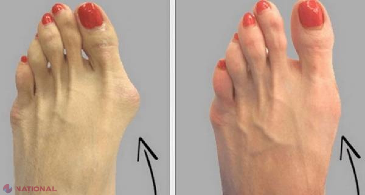 Oare de ce nu DIVULGĂ medicii acest leac simplu? Iată cum poţi scapă de bursita picioarelor într-un mod perfect natural!