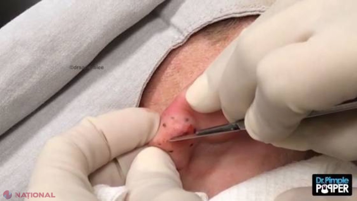 VIDEO // S-a trezit că i se umflă lobul urechii şi, după câteva săptămâni, a intrat în panică şi a mers la doctor! Ce a ieşit de acolo după ce a făcut incizia asta cu bisturiul 