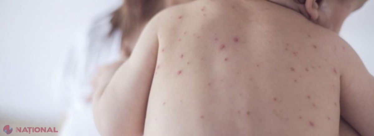 Patru cazuri suspecte de RUJEOLĂ, în Chișinău: Un caz confirmat de rezultatele de laborator. La nivel de republică, peste aproape 300 de bolnavi