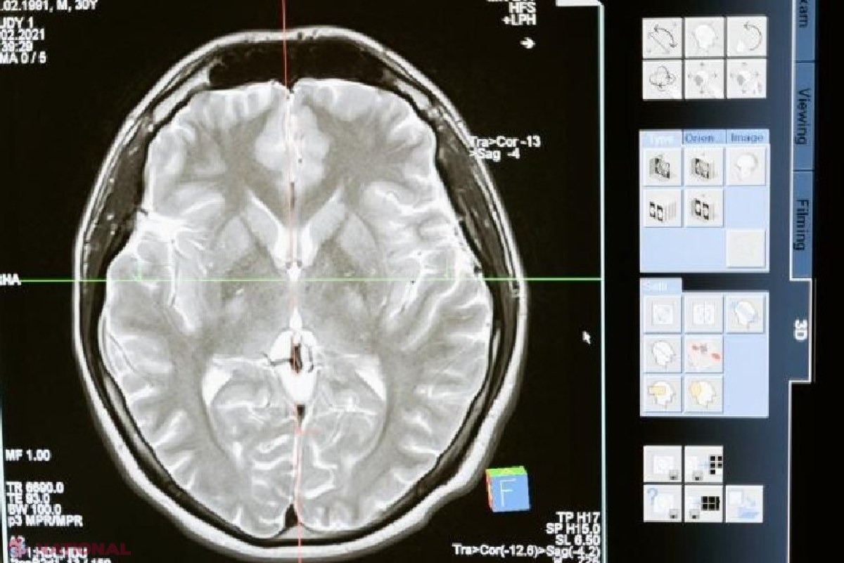 Speranțe pentru tratarea cancerului cerebral: Cercetătorii au descoperit un medicament 100% eficient 