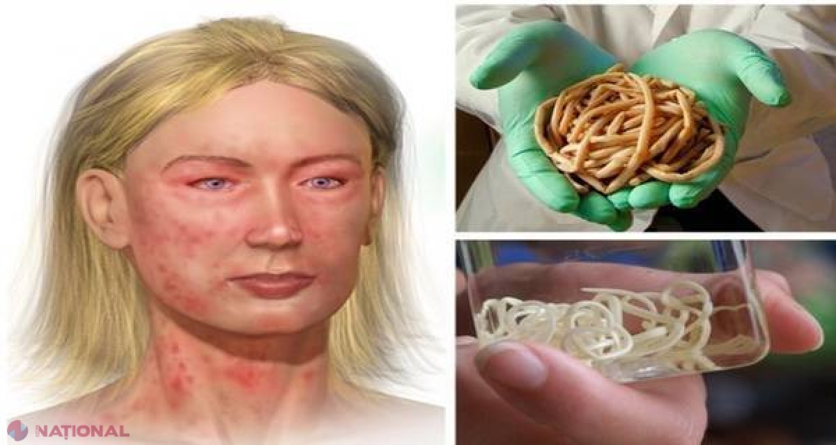 PARAZITOLOGII dau alarma! 95% din populaţia UE este infectată cu paraziţi. Află cum să te aperi tu şi familia ta...
