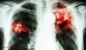 Boala contagioasă care te poate OMORÎ în câteva luni dacă nu o tratezi. Primele simptome sunt tusea și oboseala permanentă