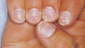 Ai pete albe pe unghii? Nu mai ignora acest semn! Uite ce înseamnă acest lucru 