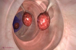 DESCOPERIRE // Acest remediu ucide 93% dintre celulele de cancer la colon în doar două zile!