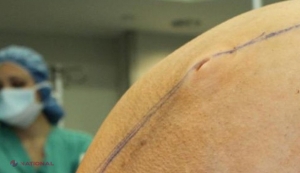 INCREDIBIL // Tumoră de 60 de kilograme, îndepărtată de pe ovarul unei femei