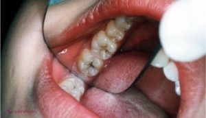 Adio, DENTIST! Pasta-minune FĂCUTĂ ÎN CASĂ te scapă RAPID de carii