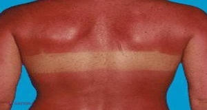 UTIL // Cum poţi grăbi VINDECAREA arsurilor solare!