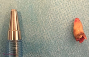 FOTO // Un bărbat a mers la spital după ce şi-a pierdut mirosul la o nară. Neştiind ce are, medicii i-au făcut tomografie. SURPRIZA de proporţii avută când s-au uitat pe rezultat