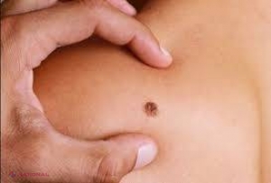 Povestea emoționantă a unei femei diagnosticate cu CANCER de piele