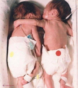 Erau două gemene născute prematur, iar medicii le-au pus în incubatoare separate, dar una dintre ele era în stare gravă! Ce s-a întâmplat când le-au adus împreună în acelaşi incubator te va impresiona