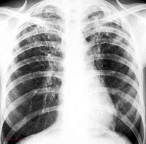 R. Moldova, inclusă în grupul de țări „cu povară înaltă de tuberculoză”