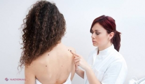 Numărul de aluniţe de pe braţe, un posibil indicator al riscului de cancer de piele