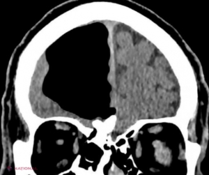 Medicii din SUA au găsit un „buzunar” de aer în locul unei părți din creierul unui pacient. Bărbatul era complet funcțional