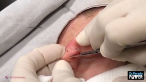 VIDEO // S-a trezit că i se umflă lobul urechii şi, după câteva săptămâni, a intrat în panică şi a mers la doctor! Ce a ieşit de acolo după ce a făcut incizia asta cu bisturiul