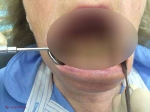 FOTO // Femeia care nu s-a spălat NICIODATĂ pe dinți. Stomatologii au rămas ȘOCAȚI!