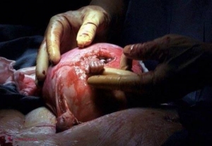 Mai ții minte fotografia EMOȚIONANTĂ a bebelușului care a scos mâna din burta mamei și a strâns degetul medicului în timpul unei operații? Iată cum arată la 16 ani 