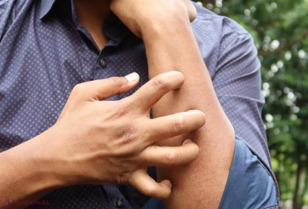 Dermatita atopică nu afectează doar pielea: boala perturbă somnul, școala și viața de zi cu zi