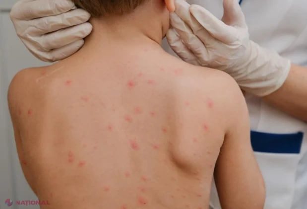 Patru oameni au murit de rujeolă în SUA în ultima lună. Apelul medicului Mihai Craiu către părinți