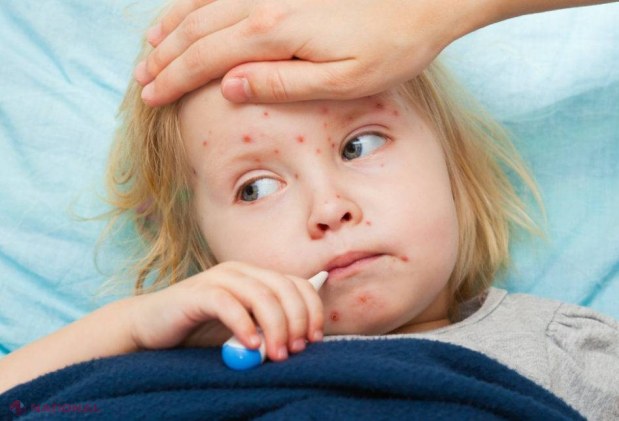 Epidemia de rujeolă ar putea ajunge în R. Moldova? Ministerul Sănătății se declară ÎNGRIJORAT
