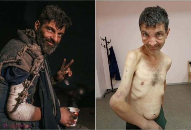 FOTO // Cum arată luptătorul de la Azovstal căruia rușii i-au smuls cu clești dispozitivul care-i fixa brațul. Mihailo a fost operat în SUA  