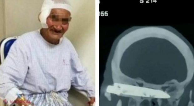 MIRACOL // Un bărbat a trăit 26 de ani cu un cuțit în cap: Nu puteam să râd, să casc sau să tușesc. Doctorii mi-au dat o nouă șansă la viață