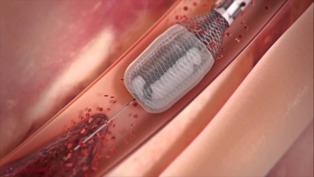 FOTO, VIDEO // INVENŢIA revoluţionară care înlătură cauza infarctului