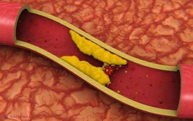 7 metode naturale de curățare a vaselor de sânge și arterelor infundate